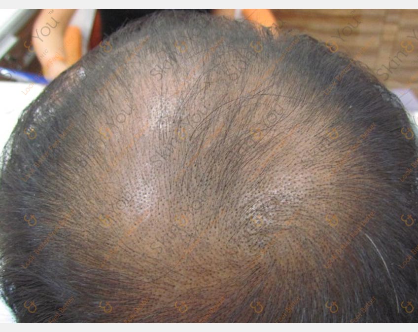 Androgenetic Alopecia