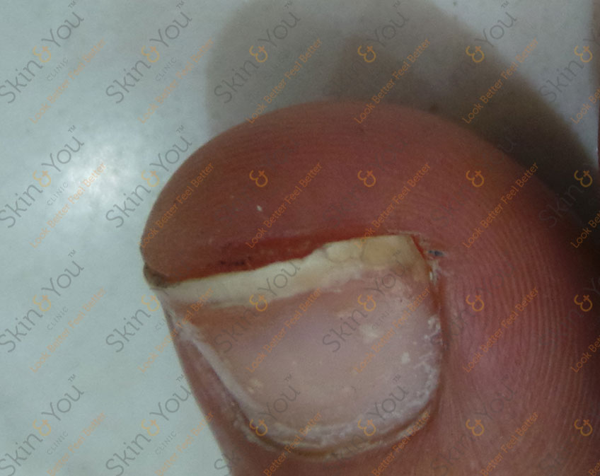 Splitting Peeling Brittle Nail