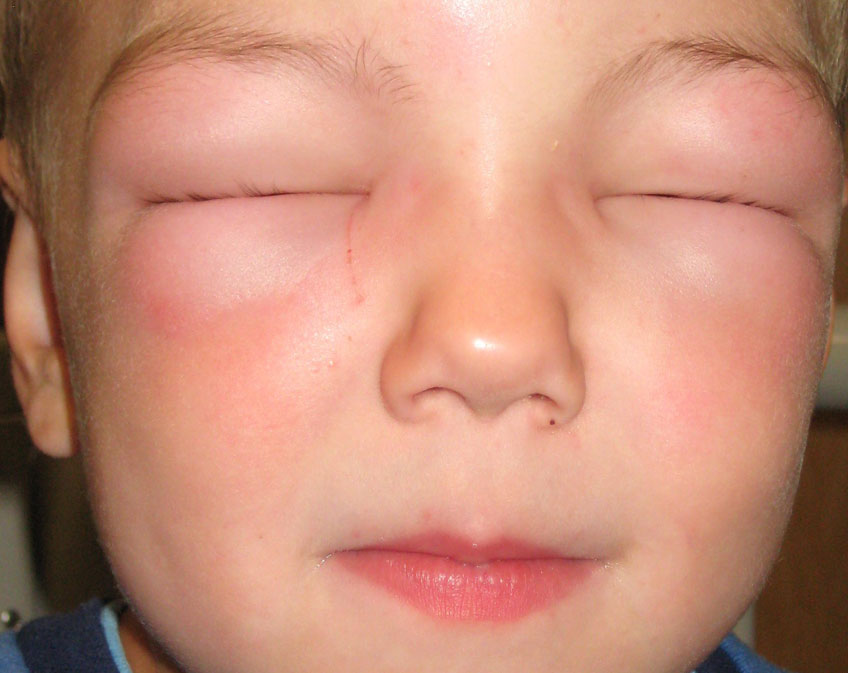 Angioedema