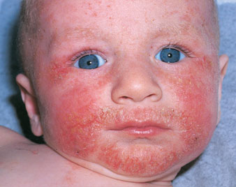 Atopic Dermatitis