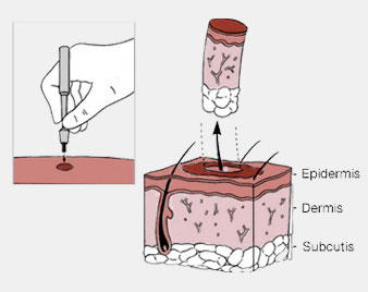Biopsy