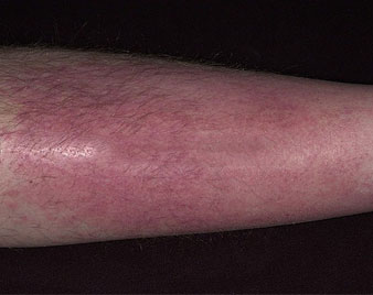 Cellulitis