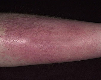 Cellulitis