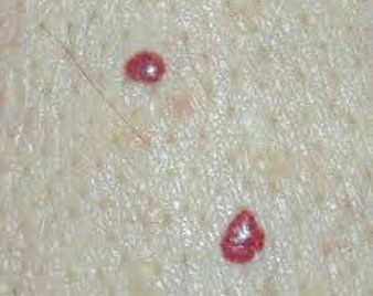 Cherry Angioma