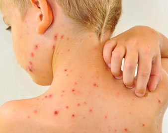 Chickenpox Varicella