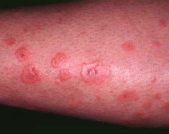 Erythema Multiforme