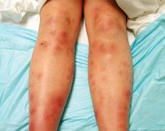 Erythema Nodosum