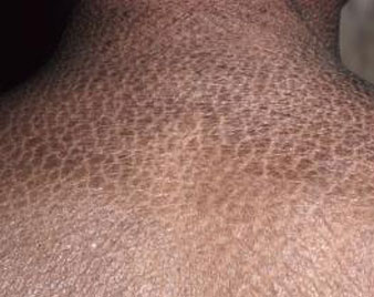 Icthyosis Vulgaris