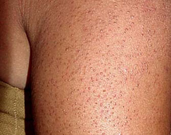 Keratosis Pilaris