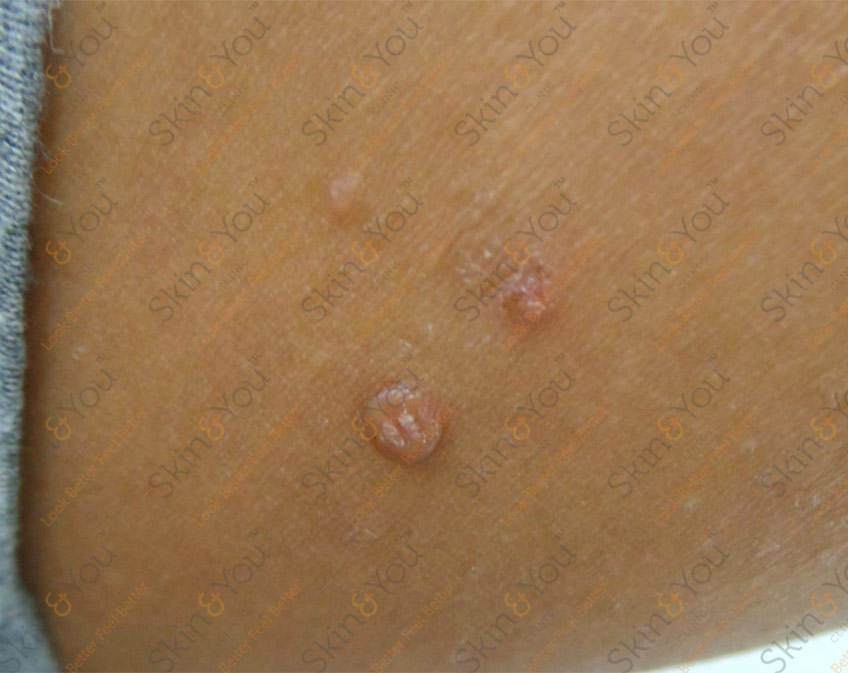 Molluscum Contagiosum