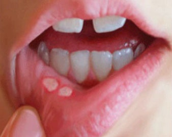 Mouth Ulcer