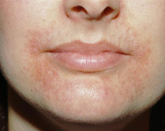 Perioral Dermatitis