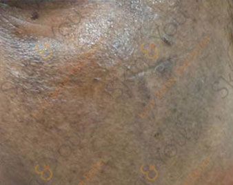 Post Inflammatory Pigmentation