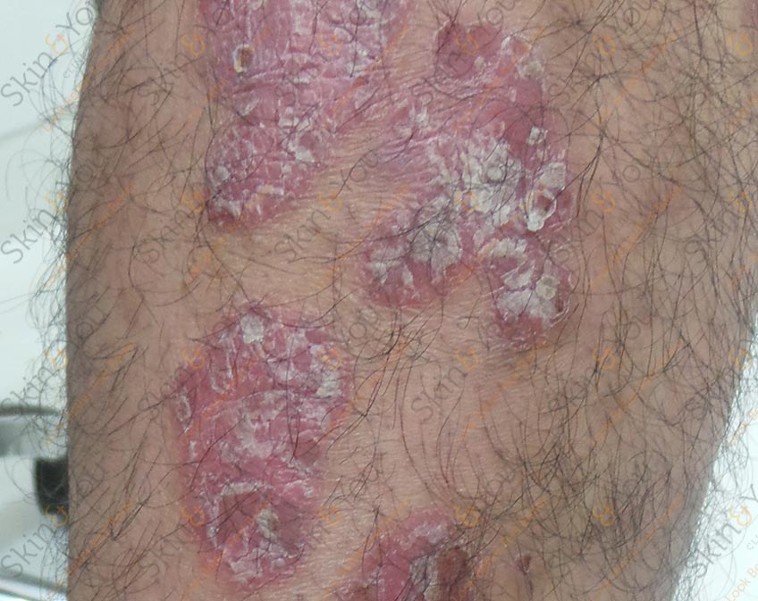 Psoriasis