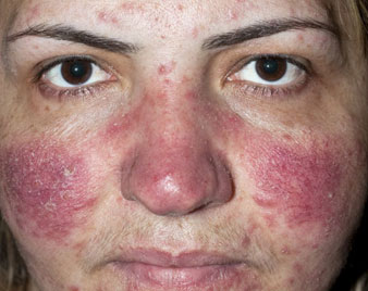 Rosacea