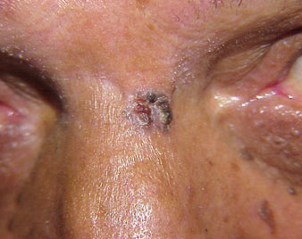 Skin Cancers