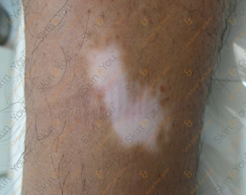 Vitiligo